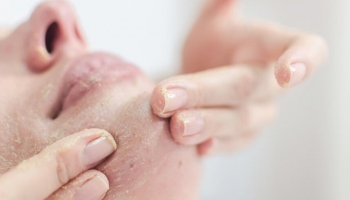 Bao lâu thì peel da 1 lần, peel da lúc nào?