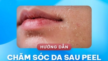 [HƯỚNG DẪN] Quy trình chăm sóc da sau peel đúng cách