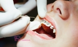 Niềng răng có đau không, các loại niềng răng phổ biến hiện nay 