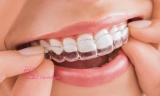 Niềng răng mắc cài trong suốt là gì, bao nhiêu tiền?