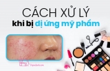 Cách phục hồi da sau dị ứng mỹ phẩm nhanh lành, hiệu quả