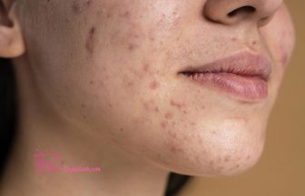 [HỎI ĐÁP] Retinol có trị thâm không tốt không?